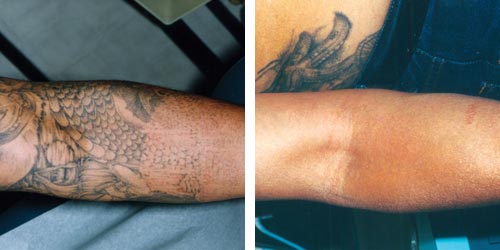 Behandling med RevLite - Tatueringsborttagning